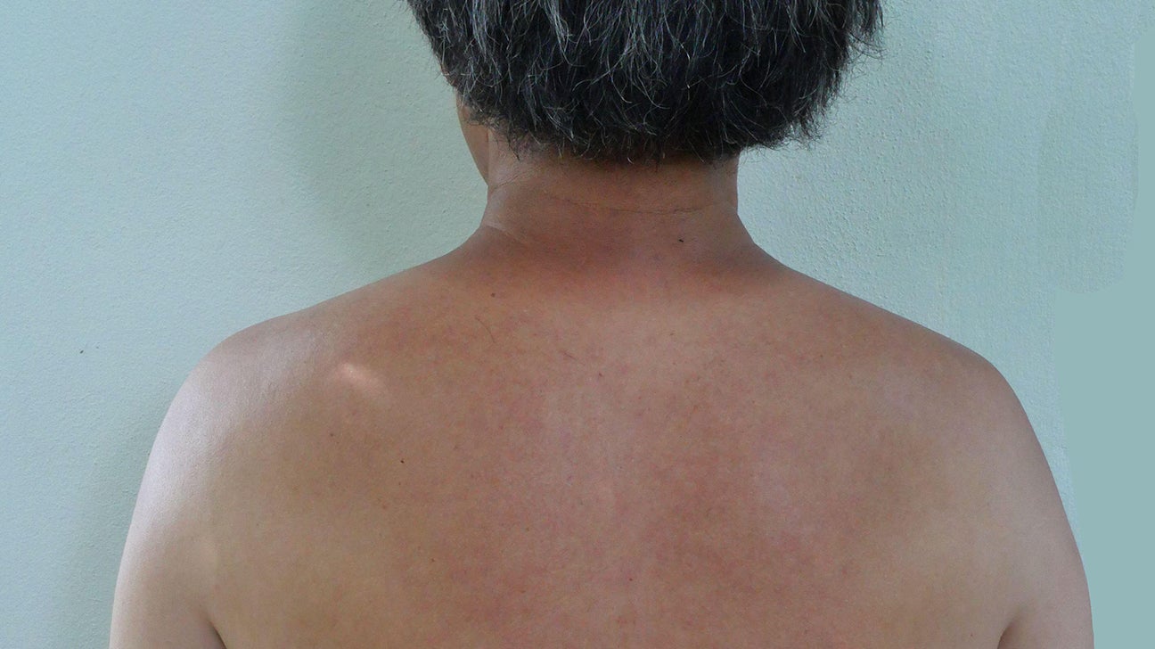 Kidney Disease Symptoms Rash