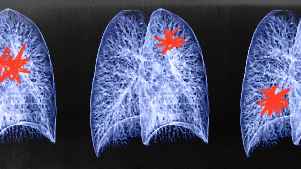 Lung Cancer Ai Tool Sybil May Be Able To Predict Risk Within 6 Years