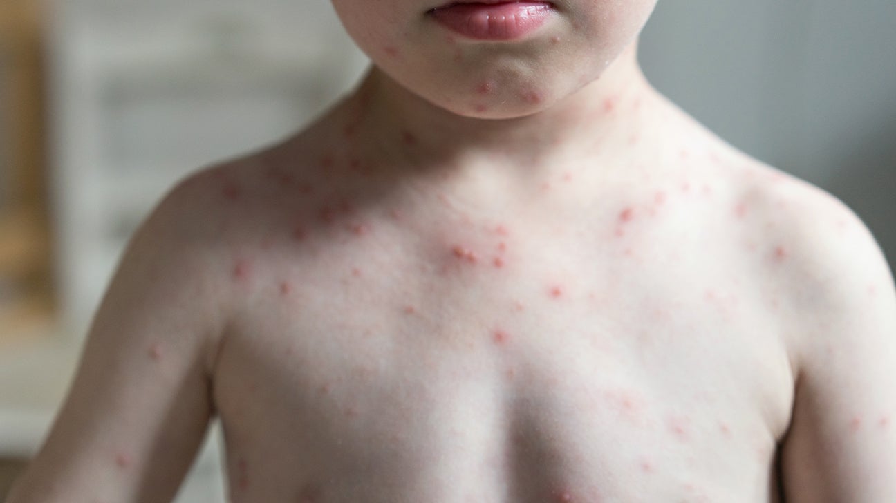 Details 148+ itching on chest hair super hot POPPY