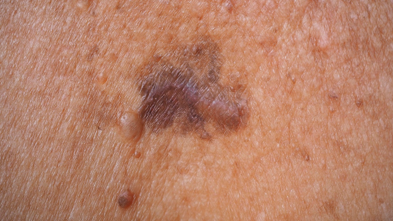 superficial basal cell carcinoma early stages
