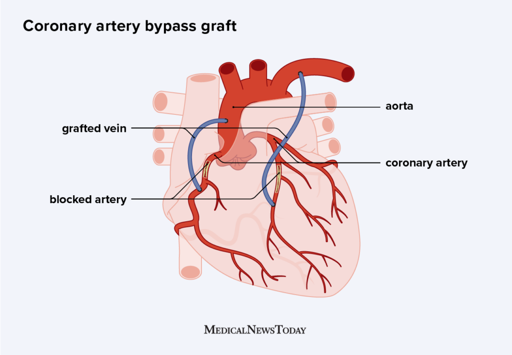 Heart Bypass Surgery Procedure Recovery Time And Risks