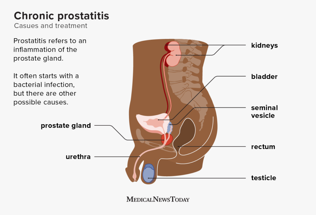 Prostatic Massage Chronic Prostatitis Treatment Kienitvc Ac Ke