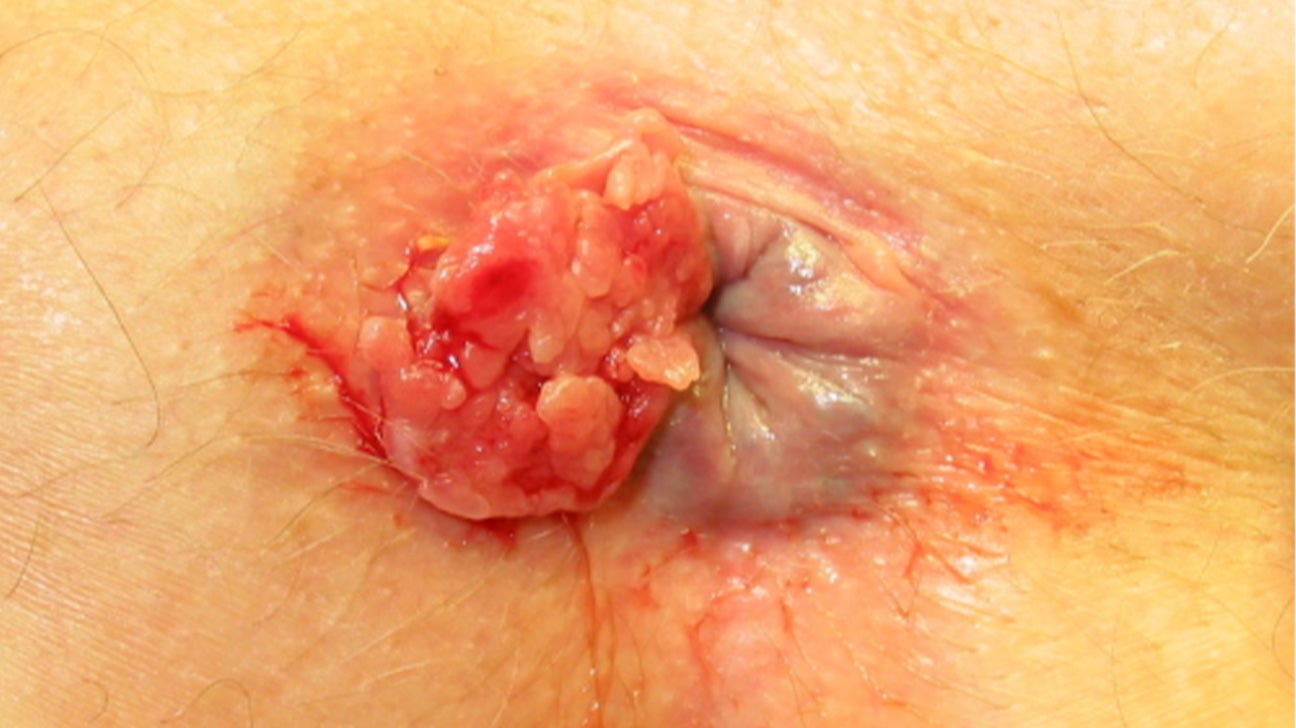 normal anus bumps