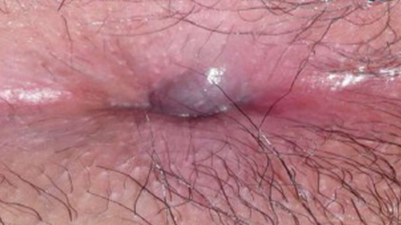 What does anal cancer look like? Pictures and other symptoms pic