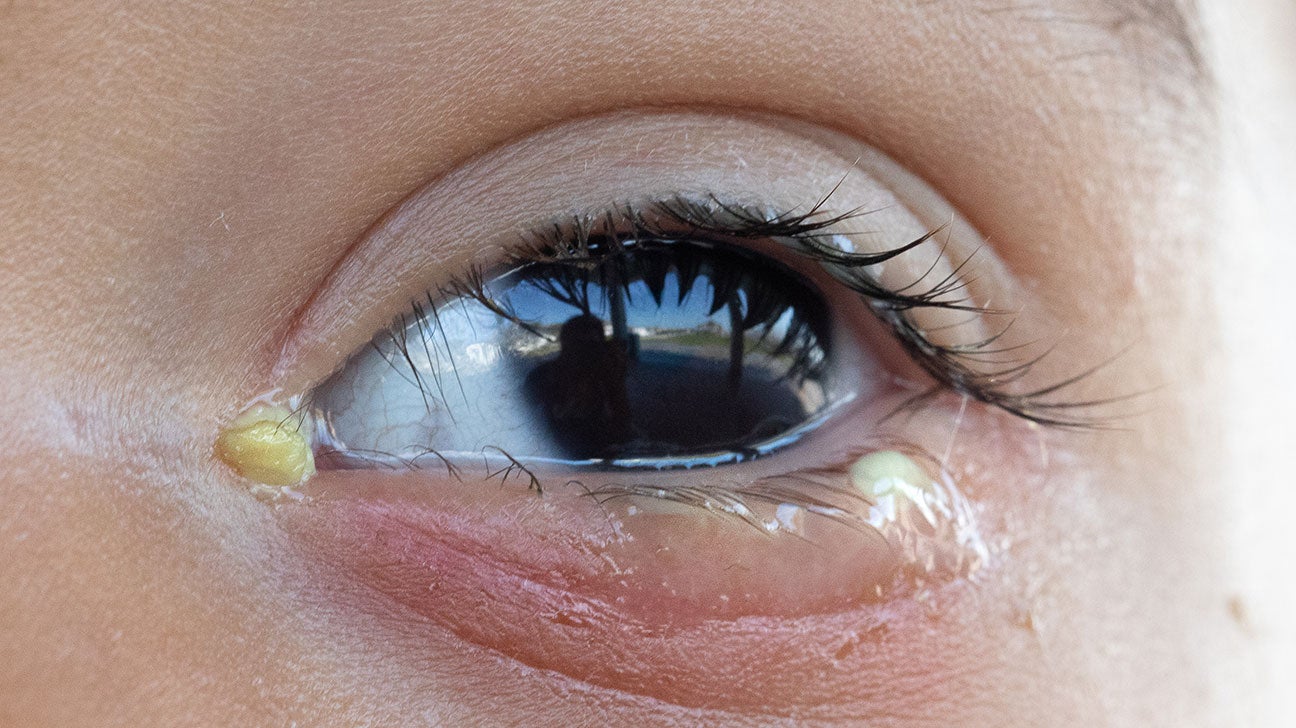 allergic-conjunctivitis-discharge