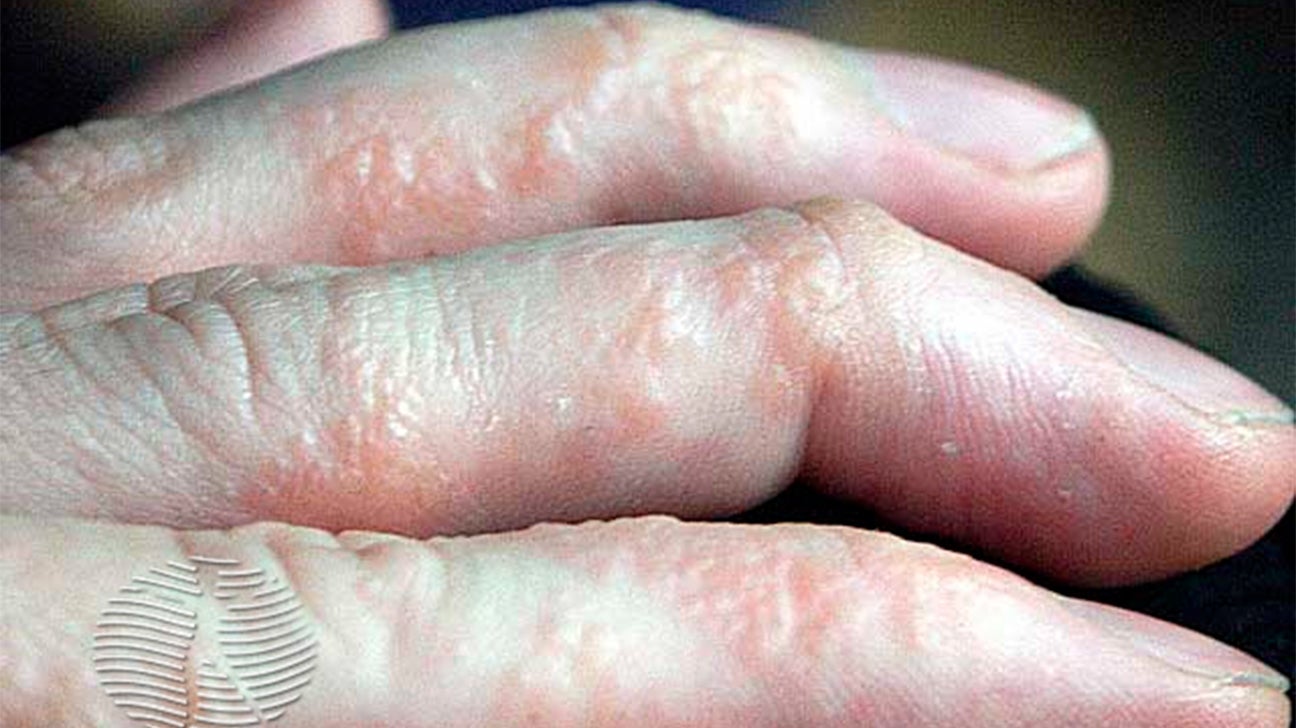 Hives On Fingers Only   Dyshidrotic Eczema Skin 1296x728 Slide5 