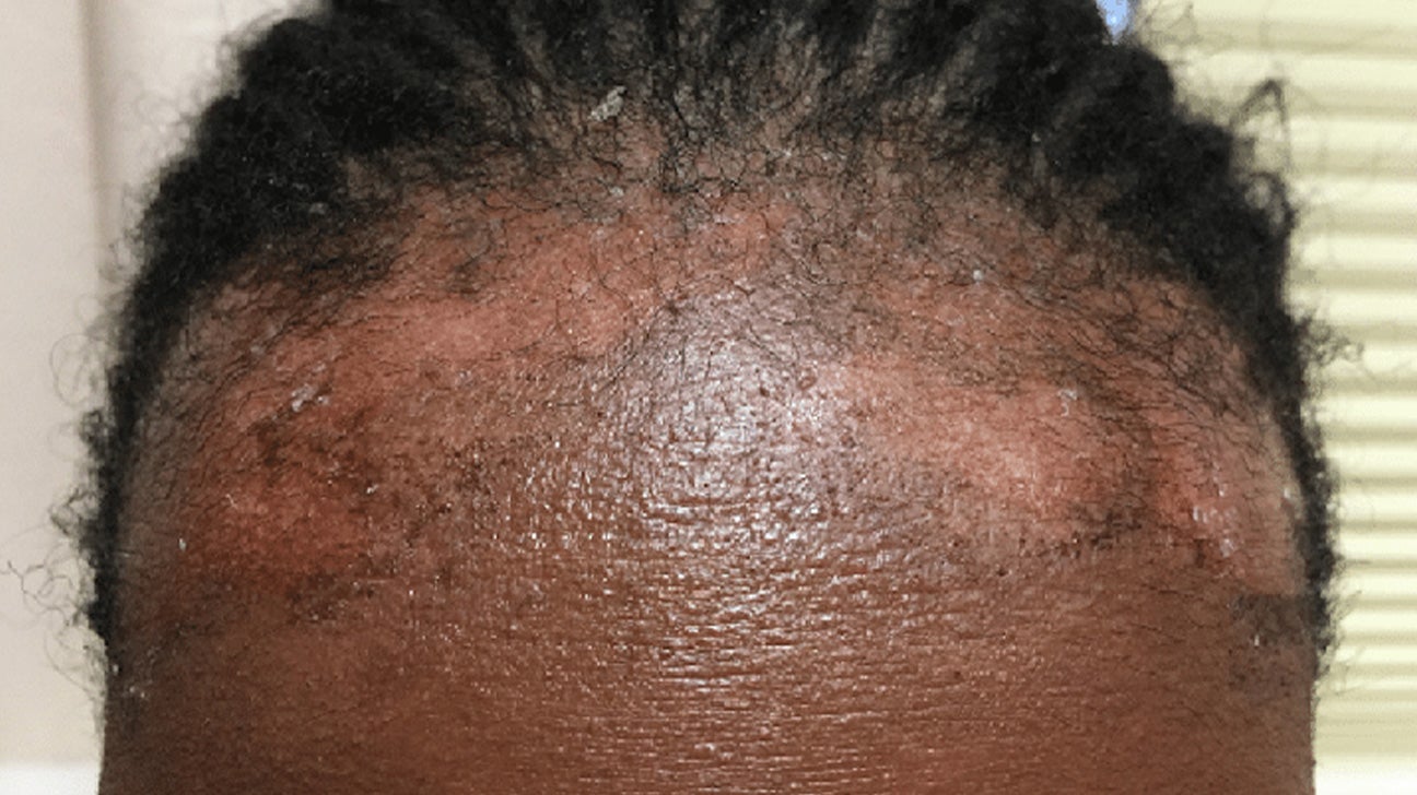 eczema scalp black people