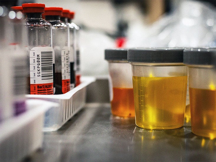 Leukocytes In Urine During Pregnancy Causes And Treatment 43 OFF