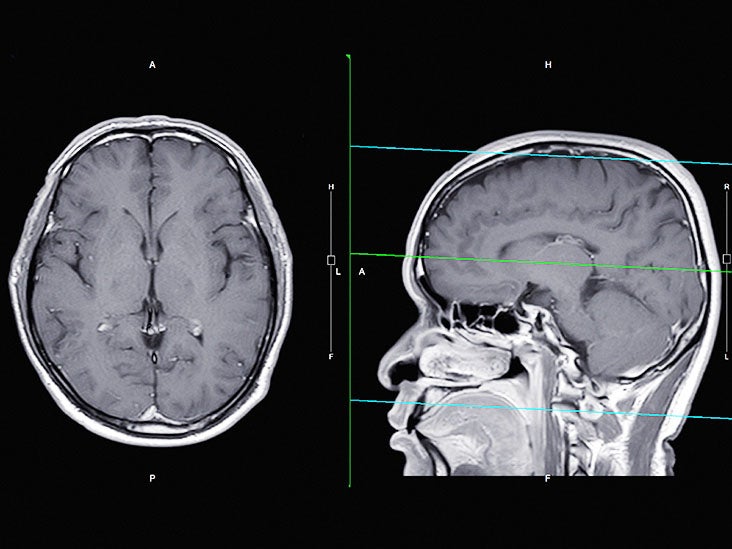 Pituitary Microadenoma What Is A Pituitary Tumor And What Causes It 