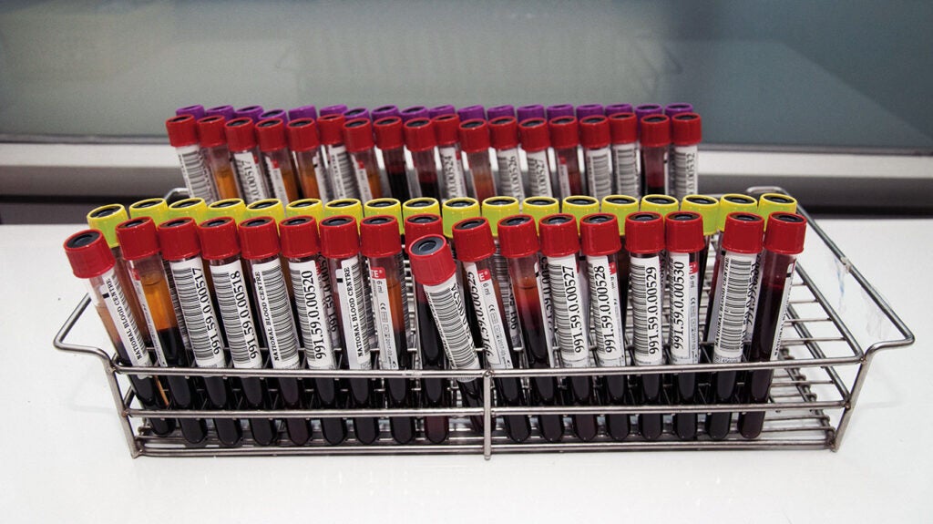 how-blood-tests-help-diagnose-different-types-of-pituitary-tumors