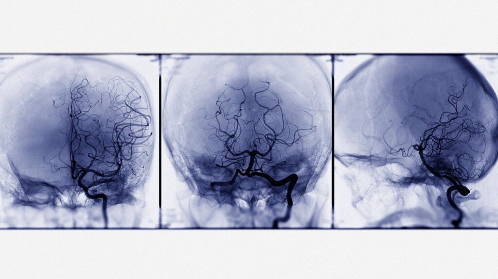 What can cause a brain aneurysm to rupture?