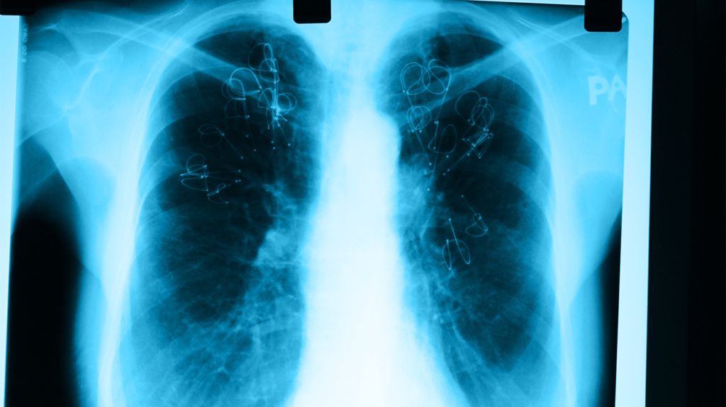 Treating severe emphysema with lung coils: How it works and risks