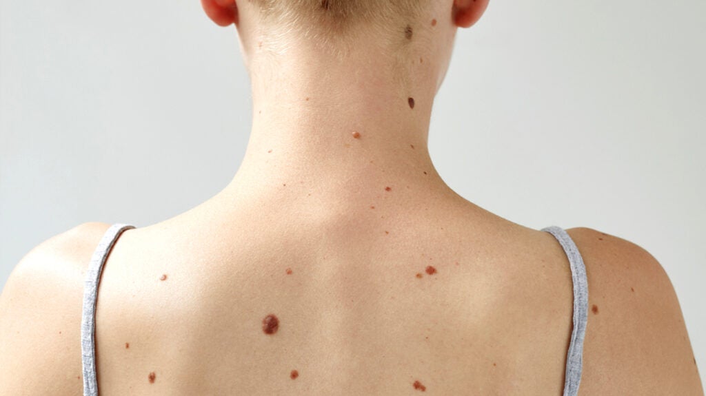 Skin Cancer Vs Mole - Forefront Dermatology