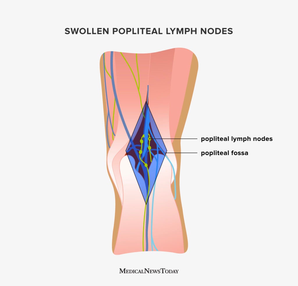 Swollen popliteal lymph nodes: Causes, anatomy, and diagnosis