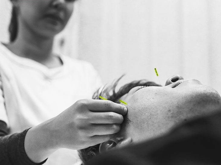 What to know about acupuncture for weight loss