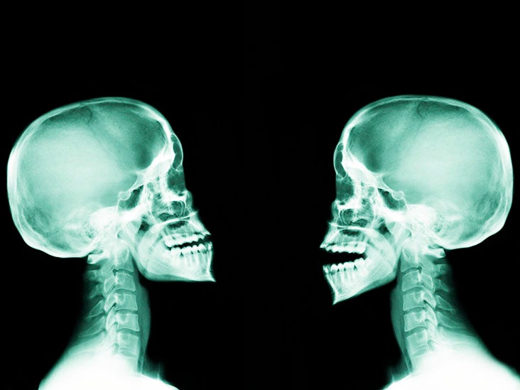 bone-cancer-effects-on-the-face