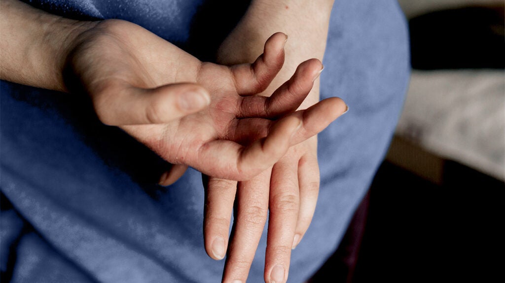 Eczema in babies Scientists say skin biomarker may help predict