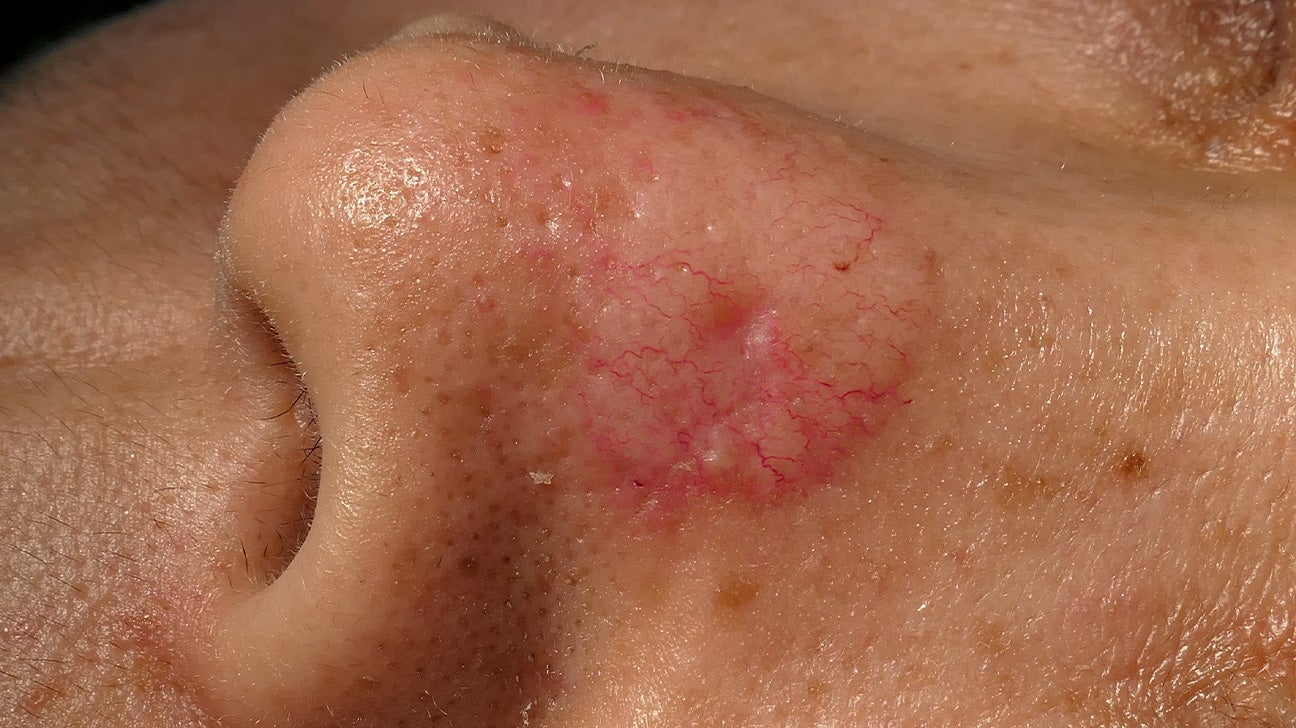 Skin Cancer Nose 1296x728 Slide2 