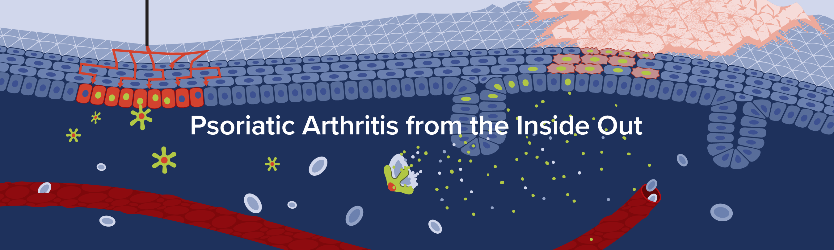 Psoriatic Arthritis from the Inside Out