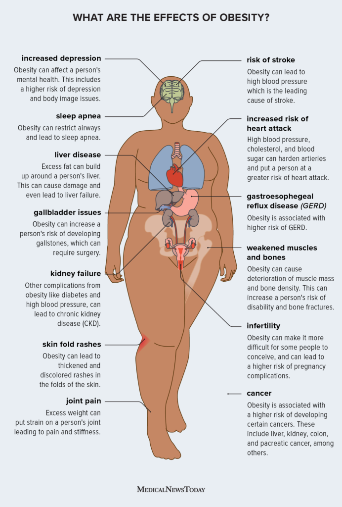 Obesity and health risks