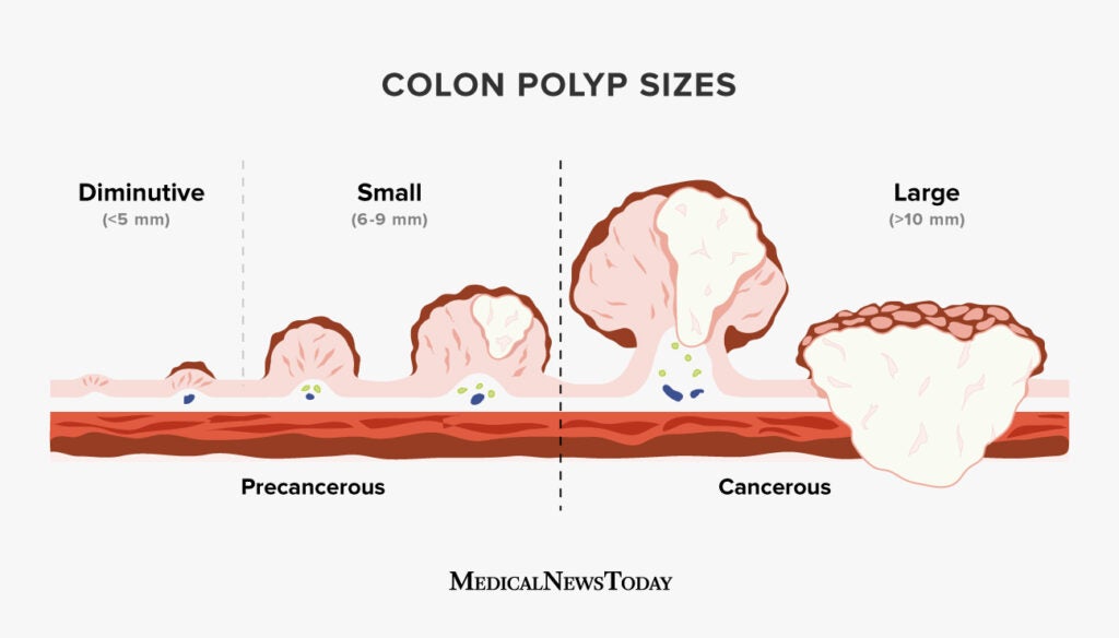 Colon Polyp Size Chart How Doctors Classify Polyps