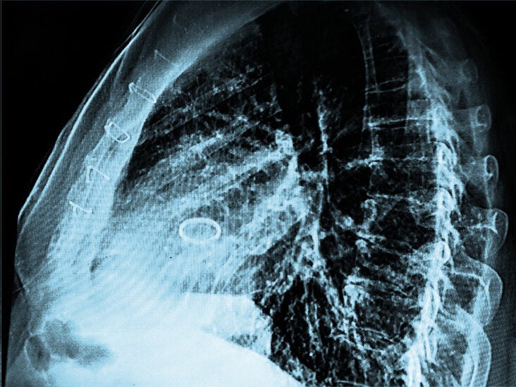Aortic stenosis: TAVR procedure more effective than open-heart surgery - Vimarsana News