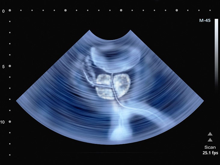 Transrectal Ultrasound: Preparation, Procedure, Cost, And More