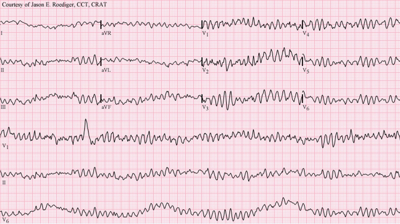ventricular fibrillation vs atrial fibrillation