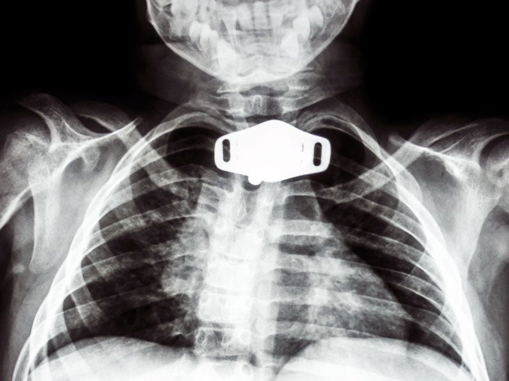 How long can you live with a tracheostomy?