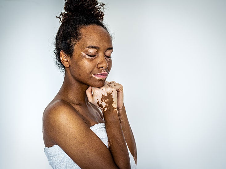 Spinal headache Symptoms, causes, treatment, and more