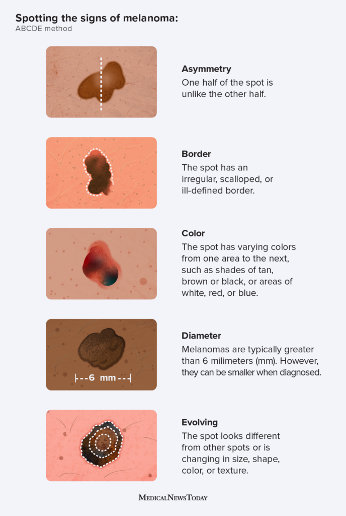 The ABCDE of skin cancer