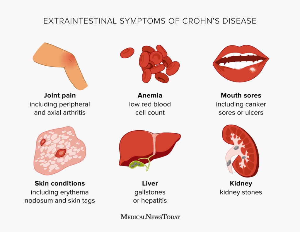 Crohn s Disease Extraintestinal Symptoms How To Cope