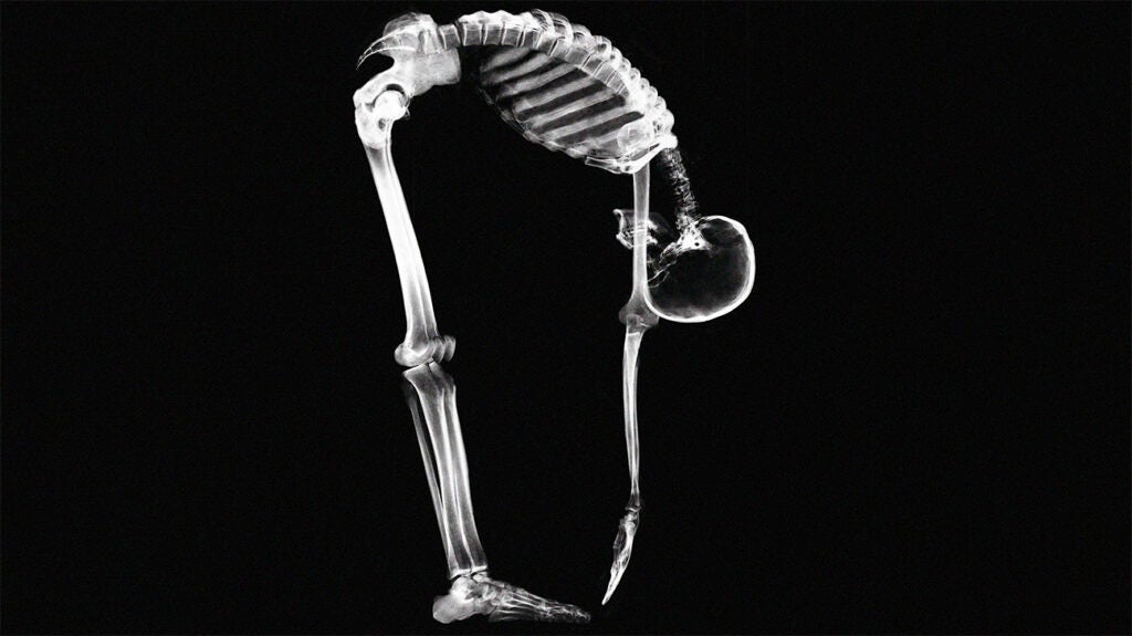 What is bone tuberculosis?