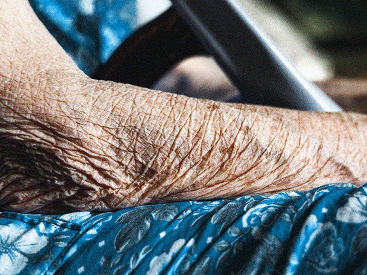 Alzheimer's: Could sleep duration and quality impact risk? - Vimarsana News