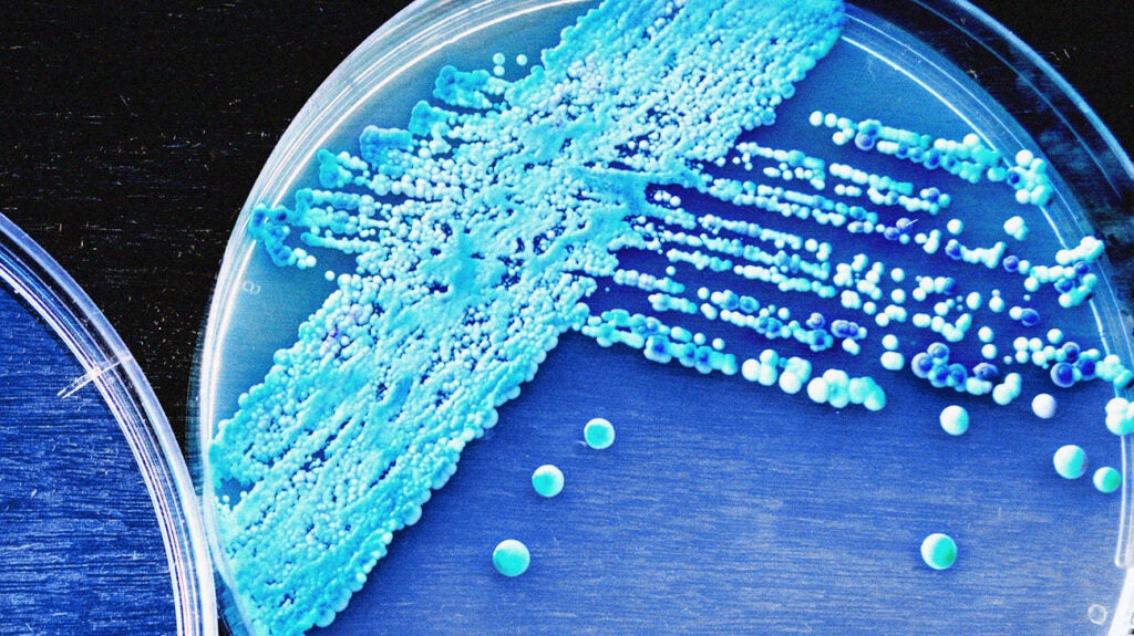 Oral thrush and HIV: What is the connection?