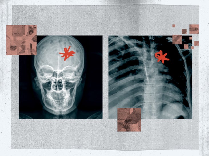 Bone cancer on the skull: Symptoms and more