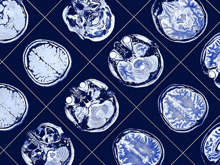 Diabetes: What impact does blood sugar have on depression risk? - Vimarsana News