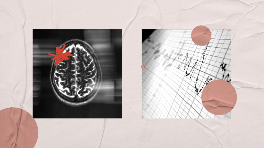 heart-attack-and-brain-damage-link-symptoms-treatment-recovery