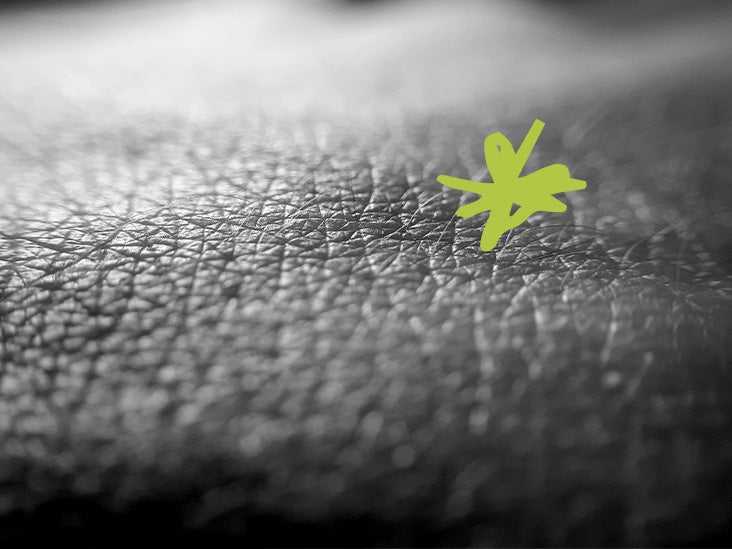 Eczema: How bacteria can accelerate the growth of skin condition - Vimarsana News