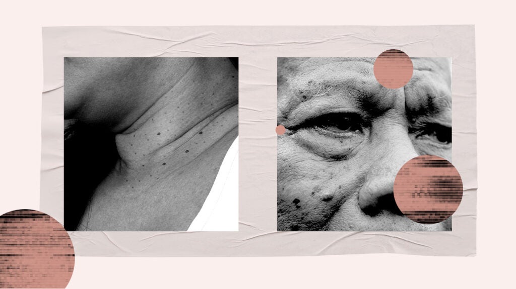 Skin tag vs. mole Differences and similarities