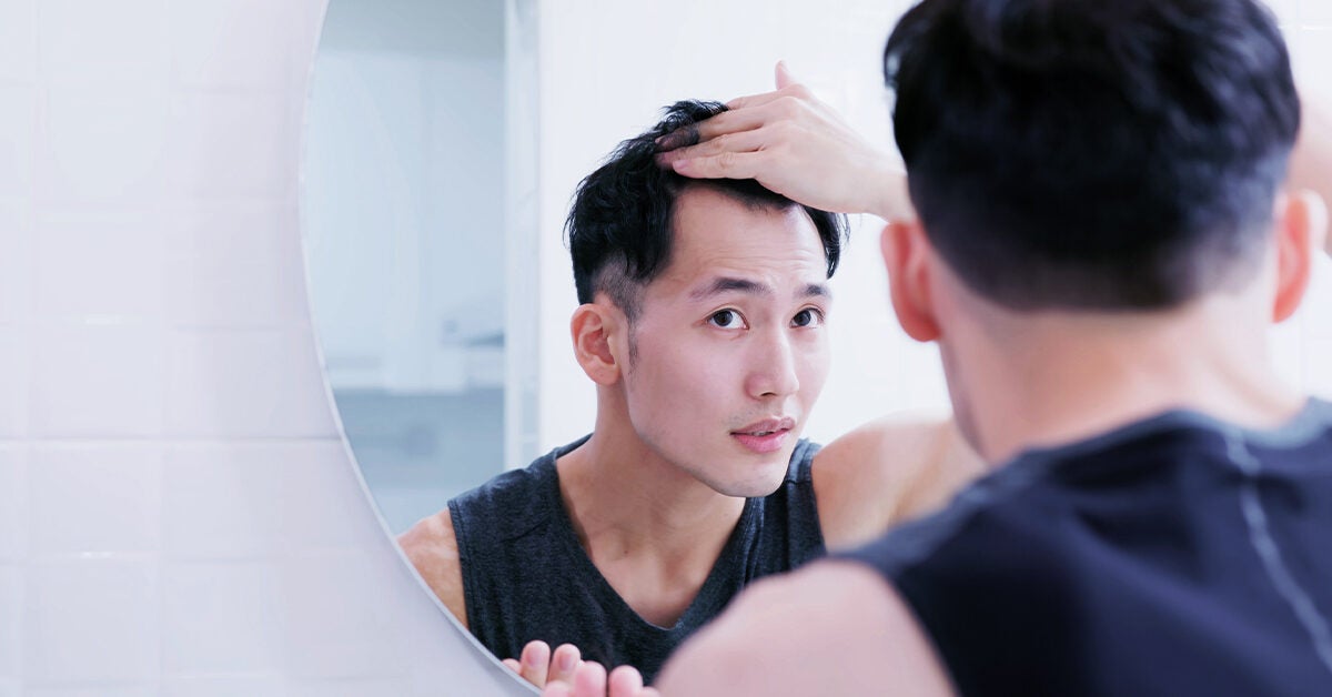 Receding hairline: Treatment, stages, and causes