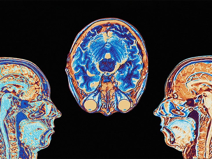 Can Seizures Cause Brain Damage 