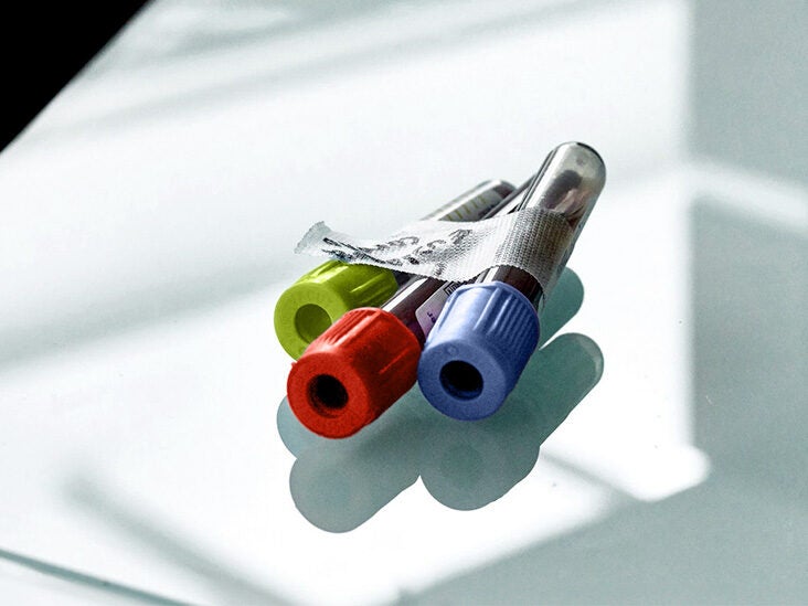 Lung cancer: How a simple blood test can help detect disease earlier - Vimarsana News