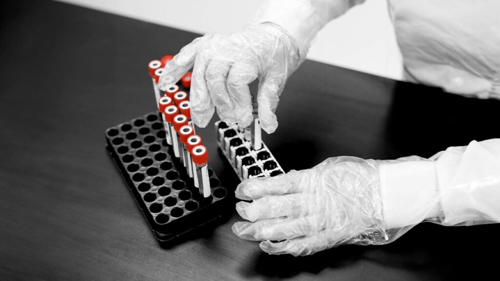 Ketonemia Definition, causes, and when to seek help