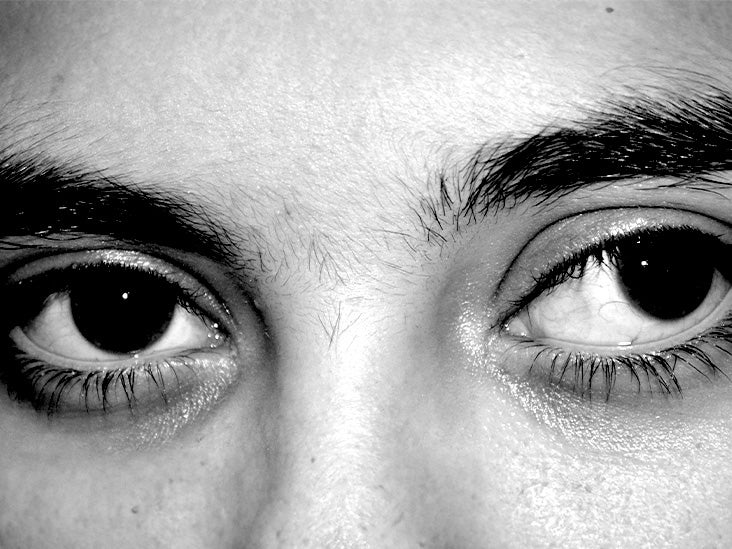 Exotropia Causes, treatment, and more