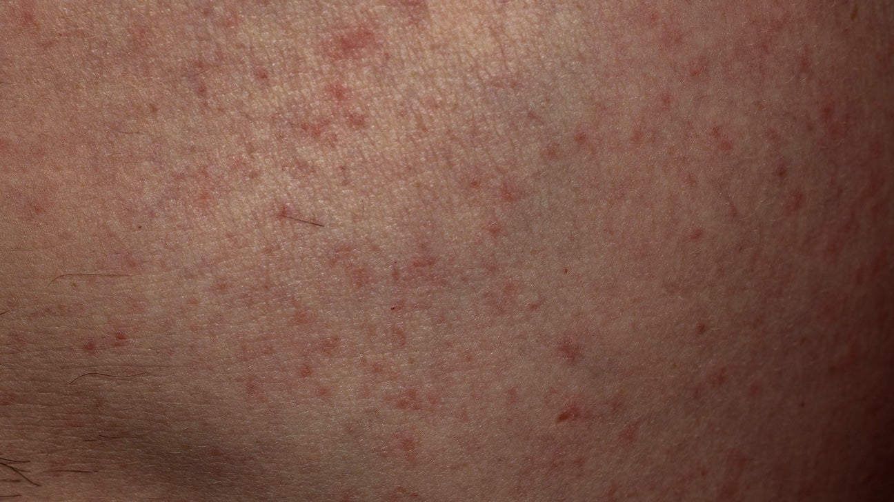 pink dots on skin