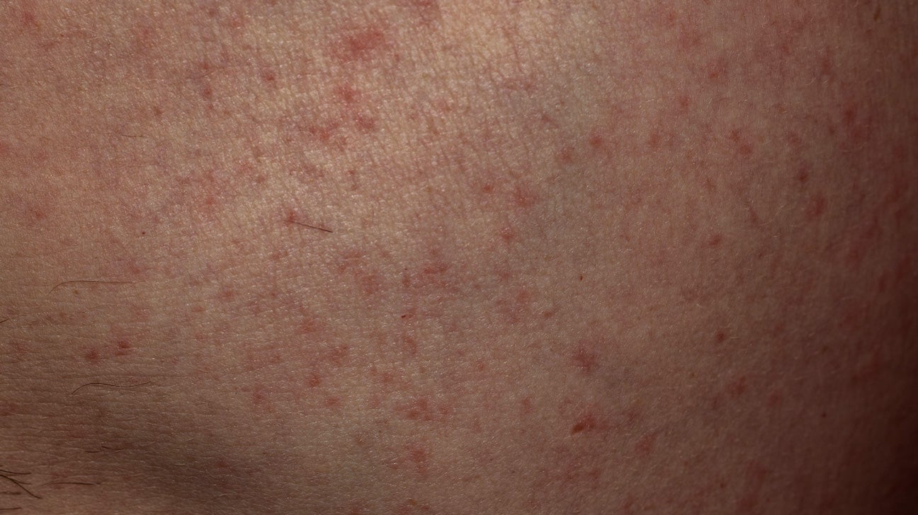 red bumps on skin not itchy