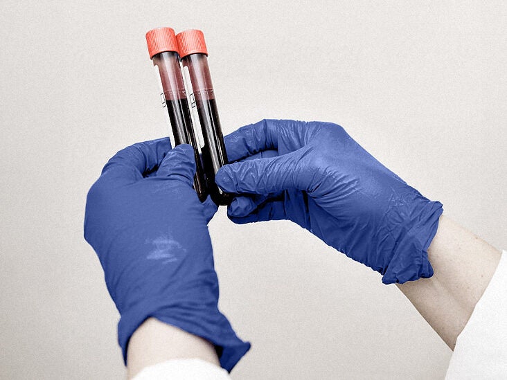 Type 2 diabetes: Blood test may help predict heart, kidney disease - Vimarsana News