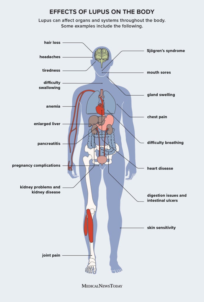 Effects and symptoms of lupus