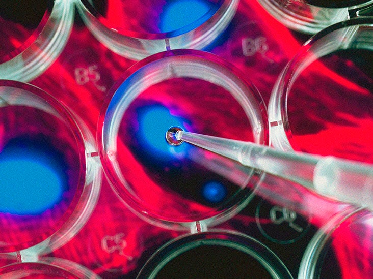 Multiple sclerosis: Benefits, obstacles of stem cell therapy for MS - Vimarsana News